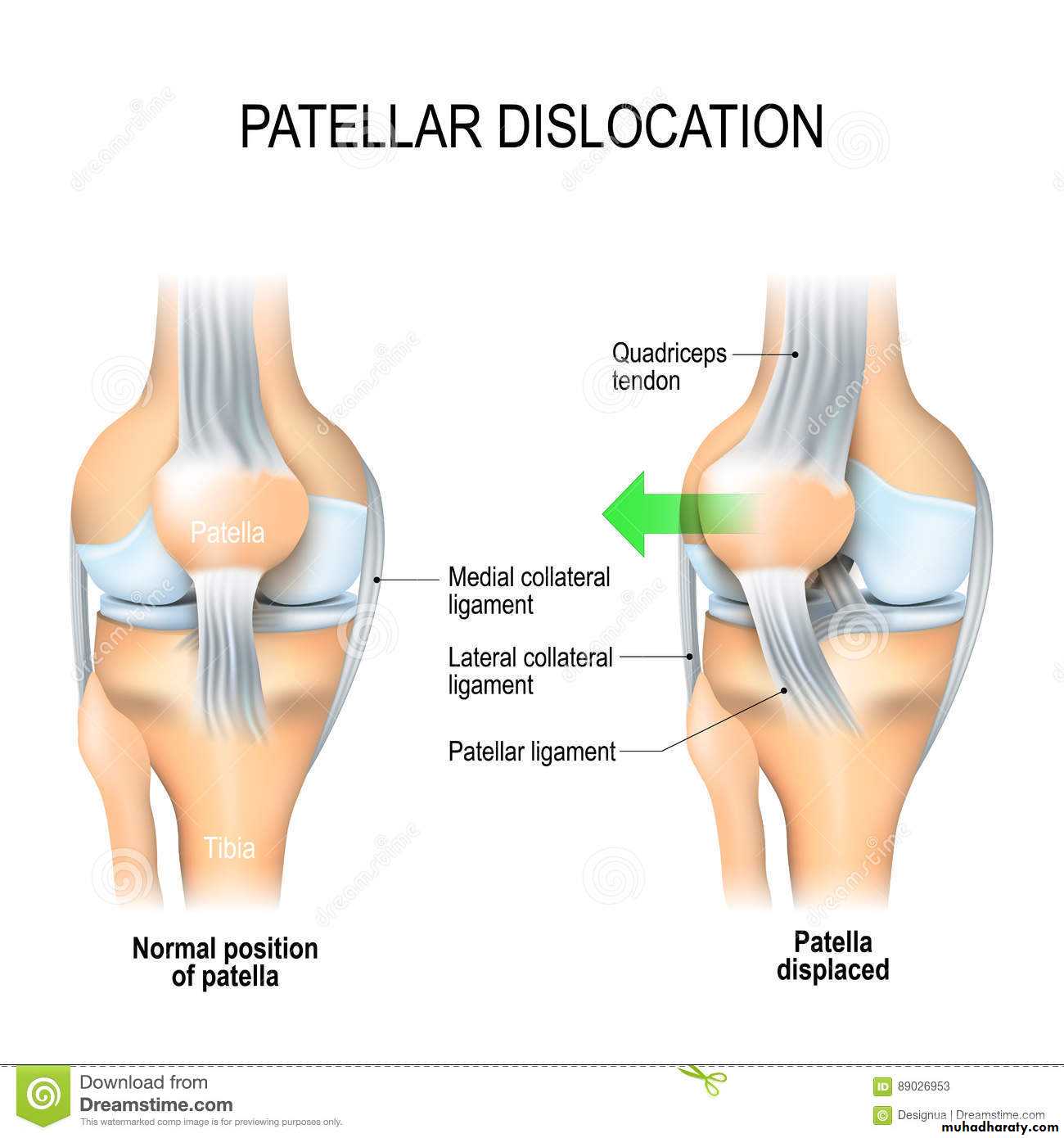 patellar dislocation