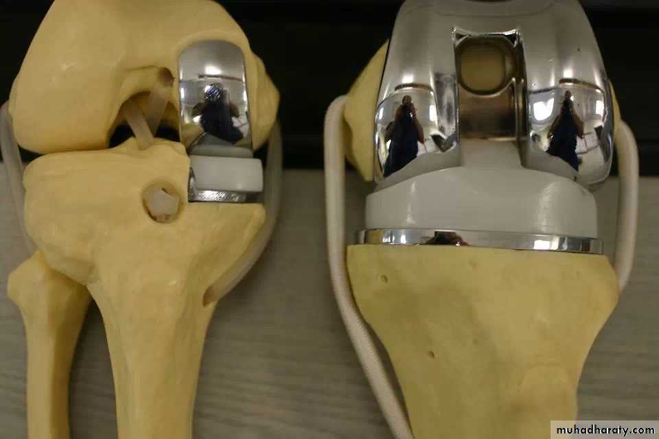 knee disease