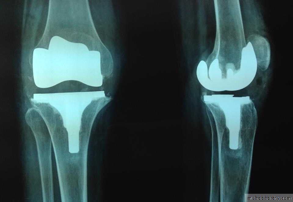 knee disease