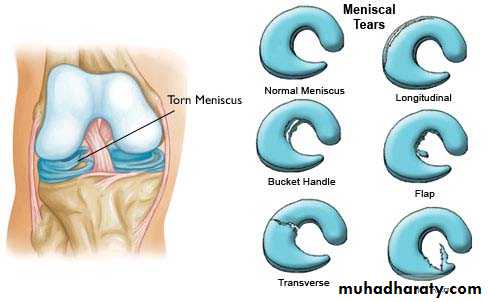 knee disease