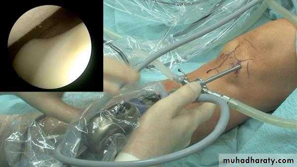 knee disease