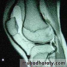 knee disease