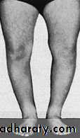 knee disease