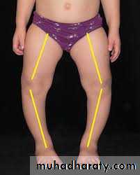 knee disease