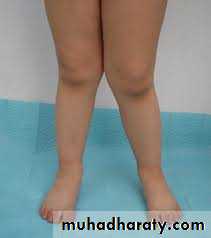 knee disease
