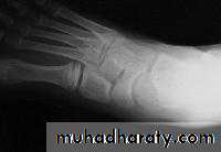 knee disease