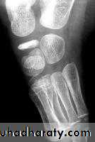 knee disease