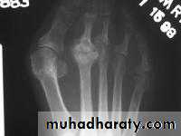 knee disease