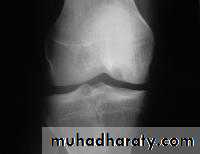 knee disease