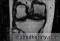 knee disease