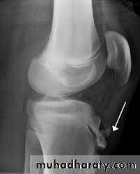 knee disease