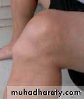 knee disease