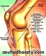 knee disease
