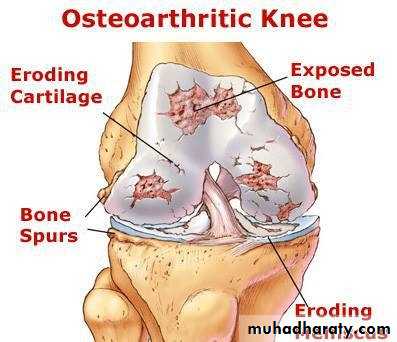 knee disease