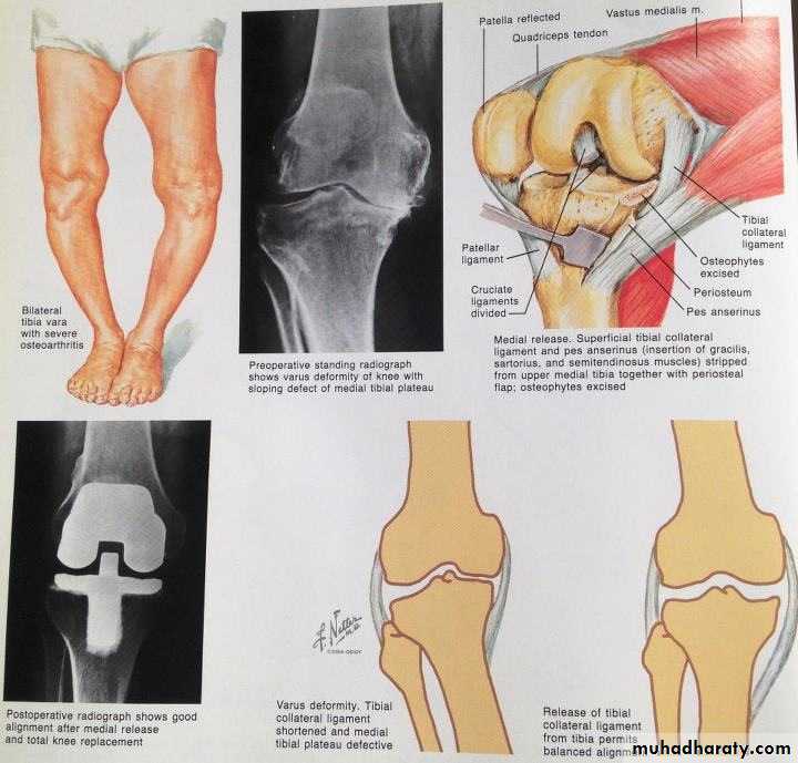 knee disease