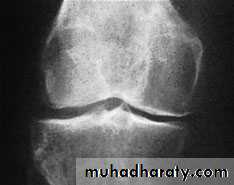 knee disease