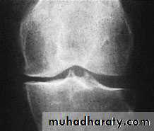 knee disease