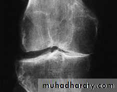 knee disease