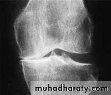 knee disease
