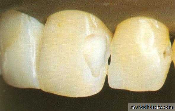 Principle of adhesion