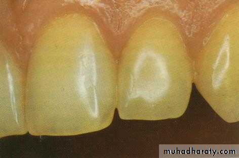 Principle of adhesion
