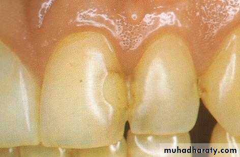 Principle of adhesion