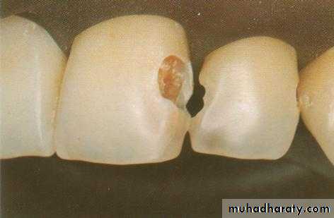 Principle of adhesion