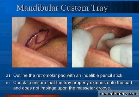 post insertion