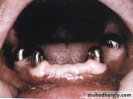 Alveolar ridge atrophy