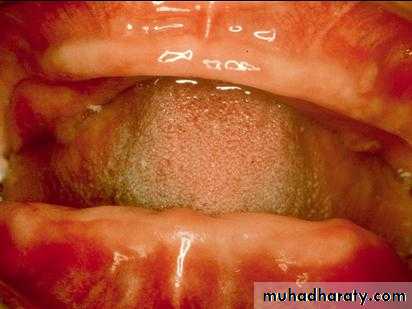 Alveolar ridge atrophy