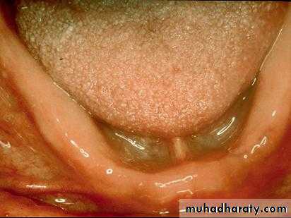 Alveolar ridge atrophy