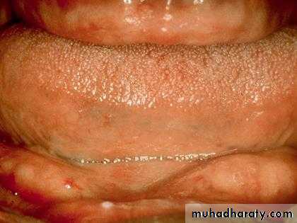 Alveolar ridge atrophy