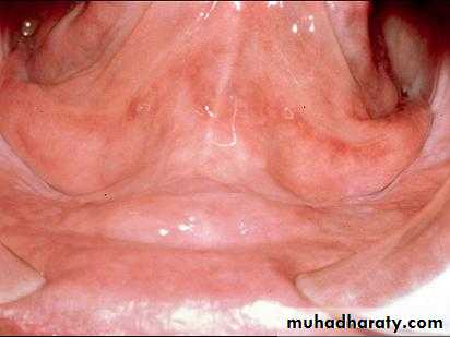 Alveolar ridge atrophy