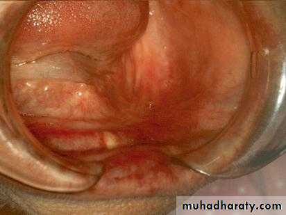 Alveolar ridge atrophy
