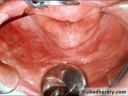 Alveolar ridge atrophy