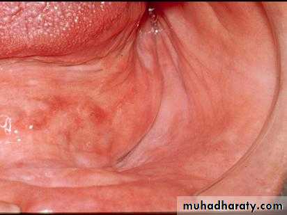 Alveolar ridge atrophy