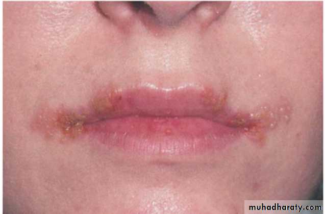 Ulcerated vesicular