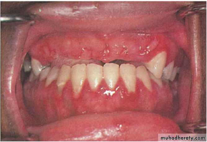 Ulcerated vesicular