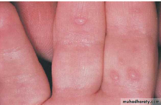 Ulcerated vesicular