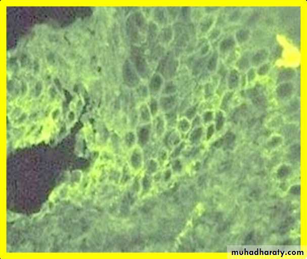 Ulcerated vesicular