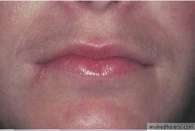 Ulcerated vesicular