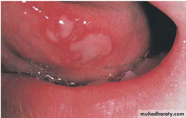 Ulcerated vesicular