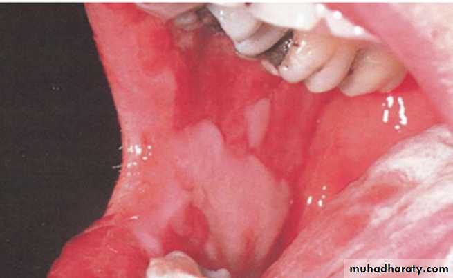 Ulcerated vesicular
