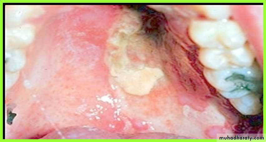 Ulcerated vesicular