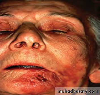Ulcerated vesicular