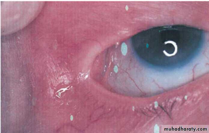 Ulcerated vesicular