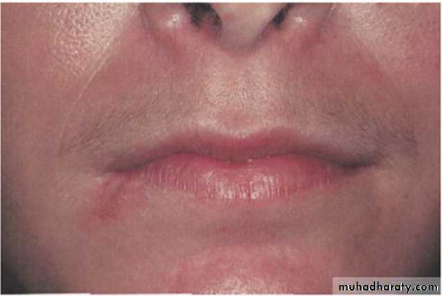 Ulcerated vesicular