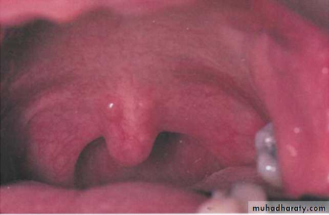 Ulcerated vesicular