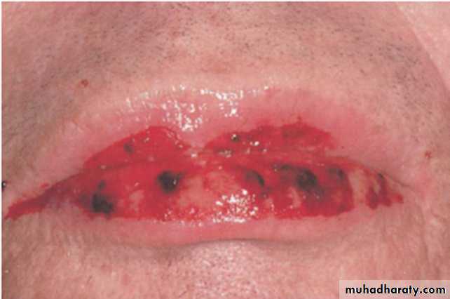 Ulcerated vesicular