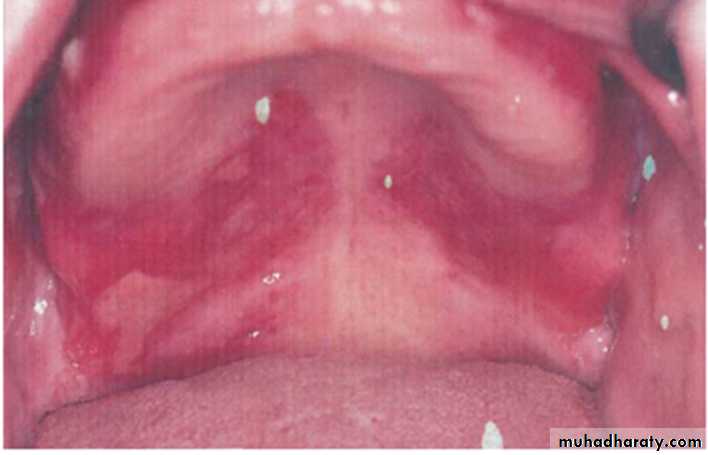 Ulcerated vesicular